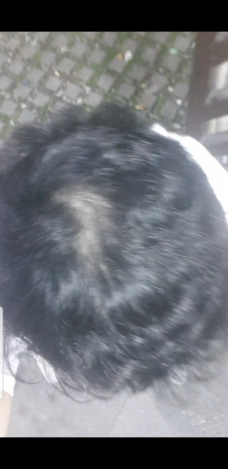 모나드정6개월 복용  전후사진