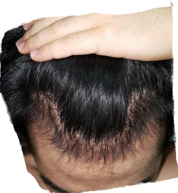 현재 좀더 숙인 각도 (머리카락이 더 많이 나 보이네요...)