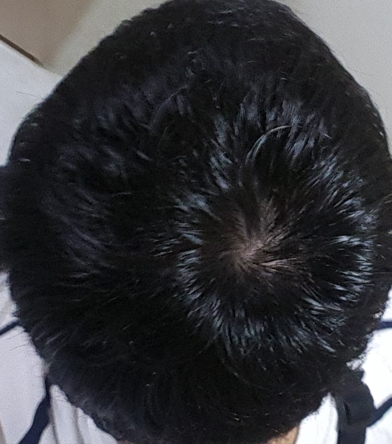 FFF7个月服用后记良好!??