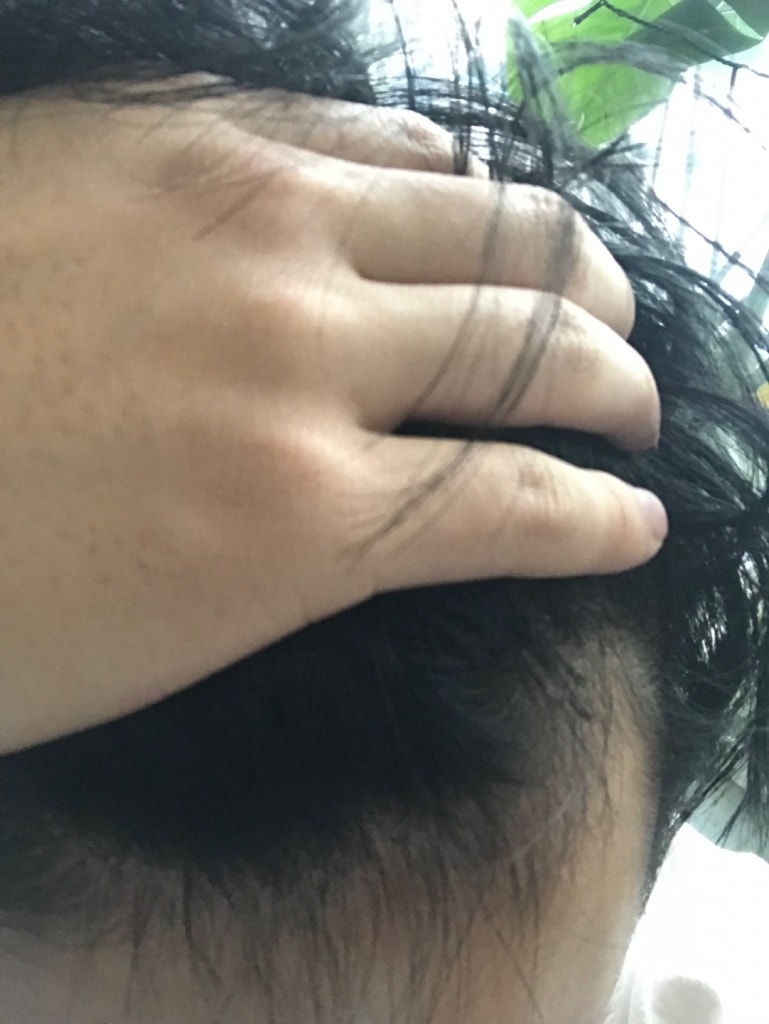 약품 바르기 전 정면 사진