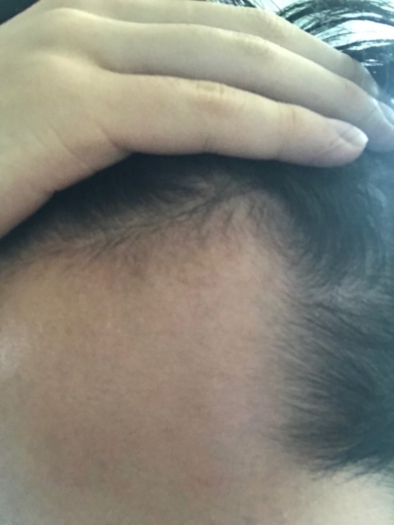Propecia + Minoxidil 6 months review (male in early 20s)