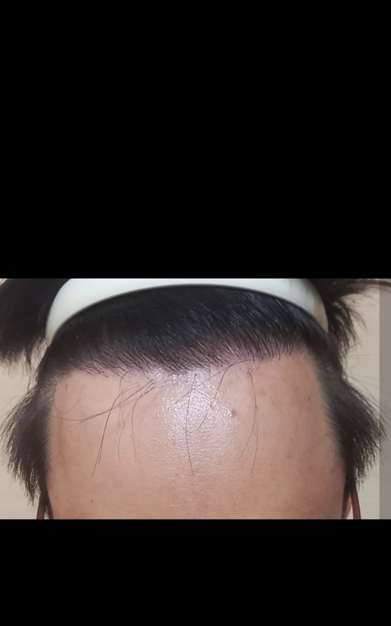 아보다트7개월차