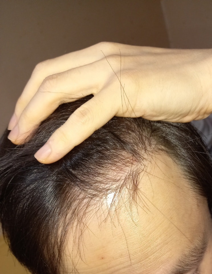 아보다트7개월후기입니다.