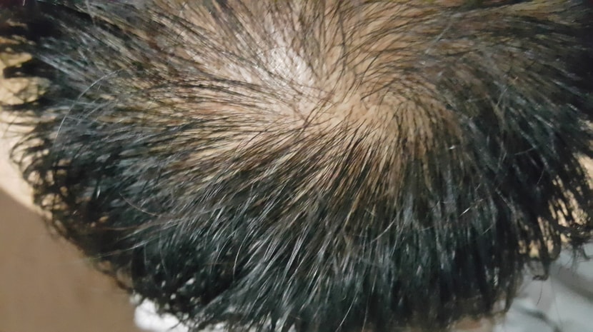 정수리