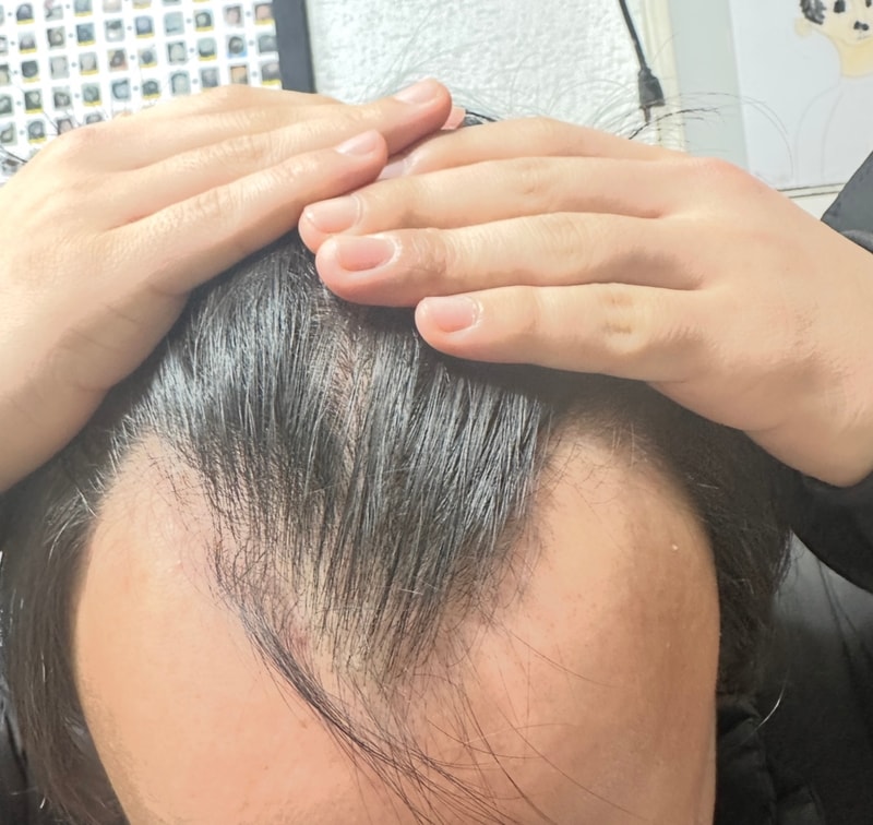 탈모약 복용 5개월 째