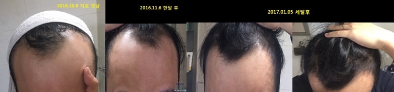 Narok+围巾+Abodote+FFCA+头皮营养剂3个月后期