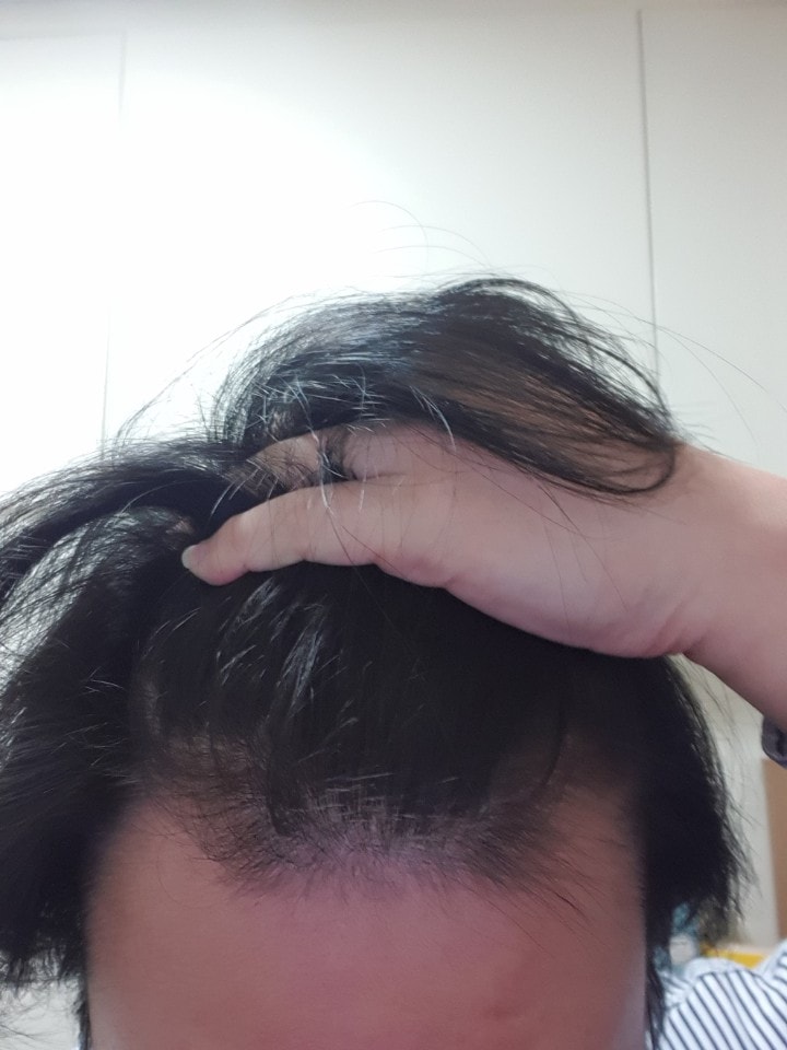 알로펙 복용 6개월 사진입니다