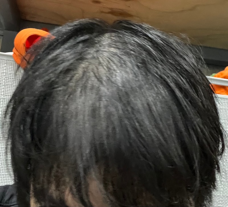 두타+미녹정 2.5mg 2주 후기