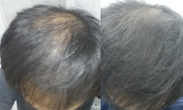 Propecia 2个月后期