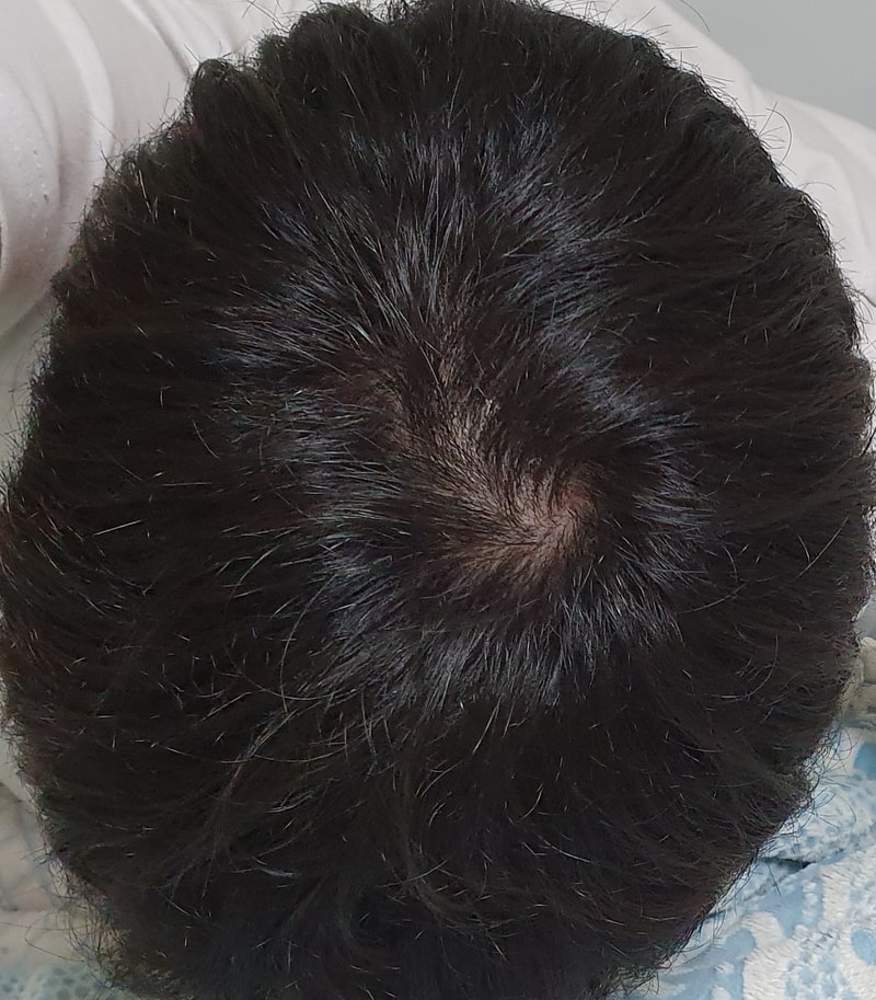 特写服用1年半Propecia后记