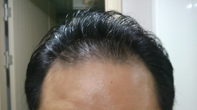 刘海儿越来越丰盛了。 （16年8月至17年2月服用脱发药的照片后记）