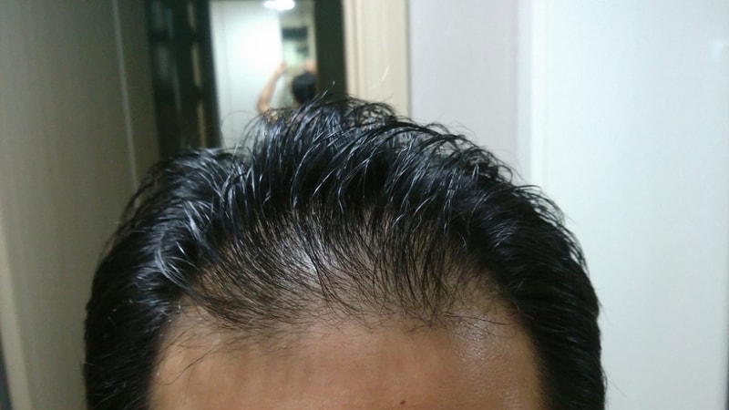 Finfacyx + Kirkland minoxidil组合 5个月后期