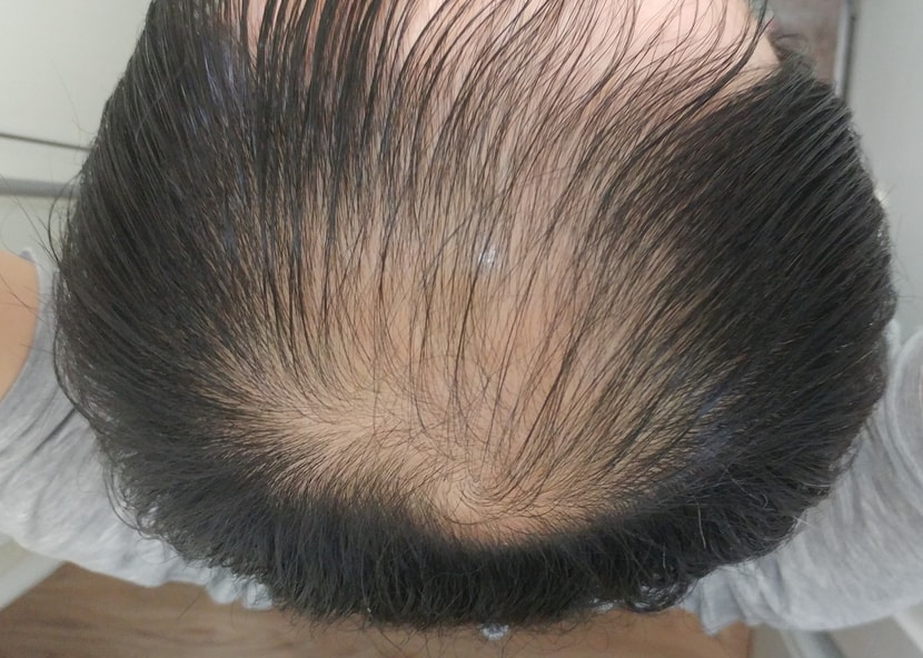 치료전 정수리