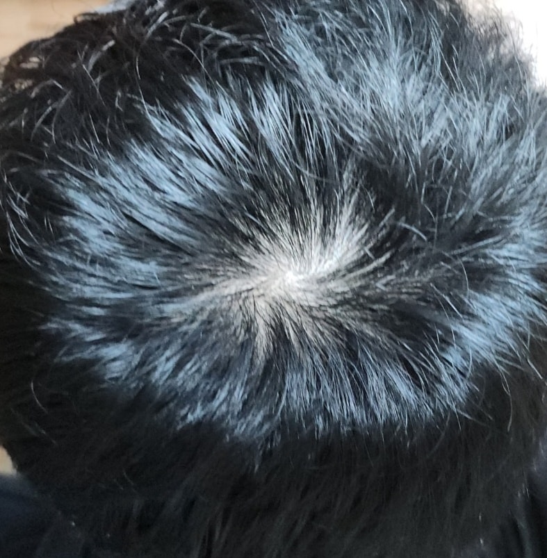 피나 6개월+ 두타 3개월