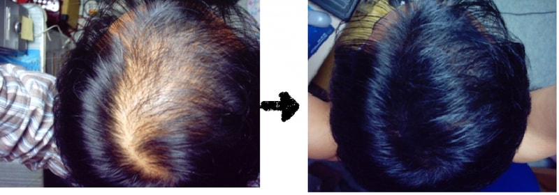 [미녹의 고민] 솜털, 결국 정상 모발이 될지 그것이 문제로다.