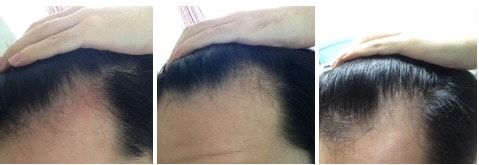 프로스카 1년, 1년 쉬고, 현재 미녹시딜 3개월차