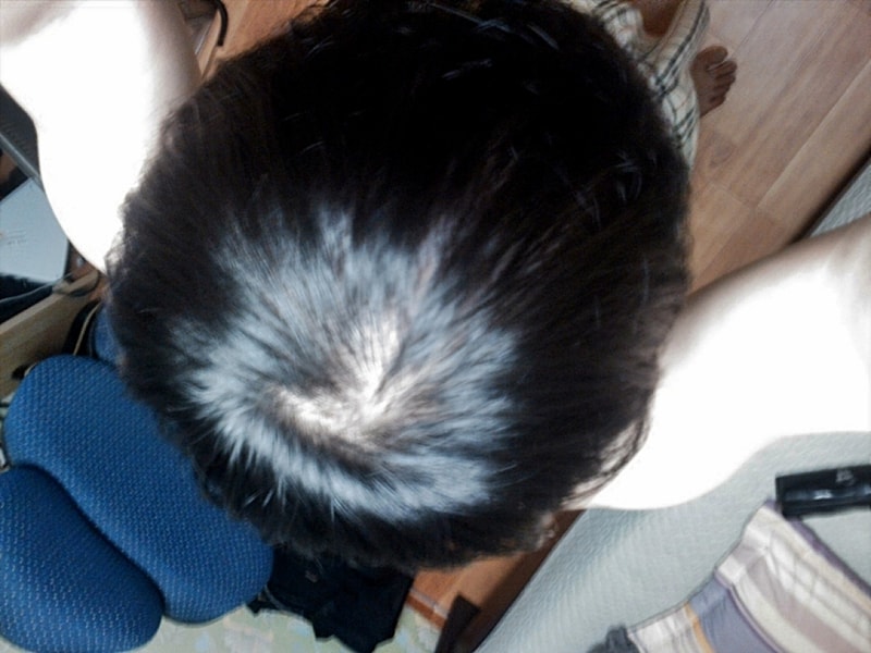 프페(프카)8개월 복용 사진....