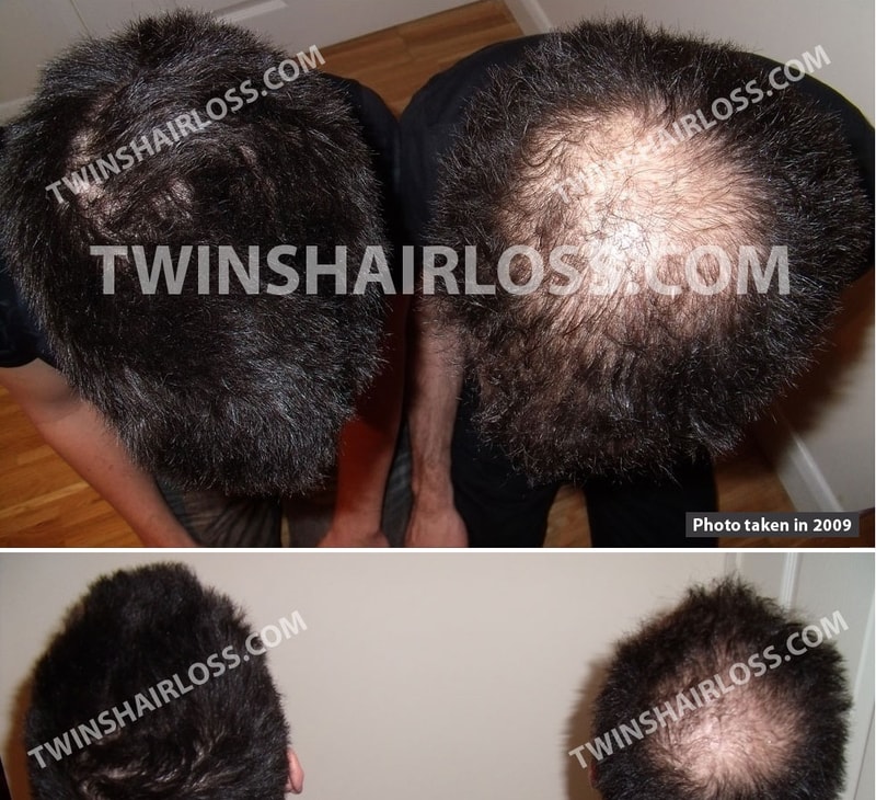 同卵双胞胎阿凡达服用3年后记