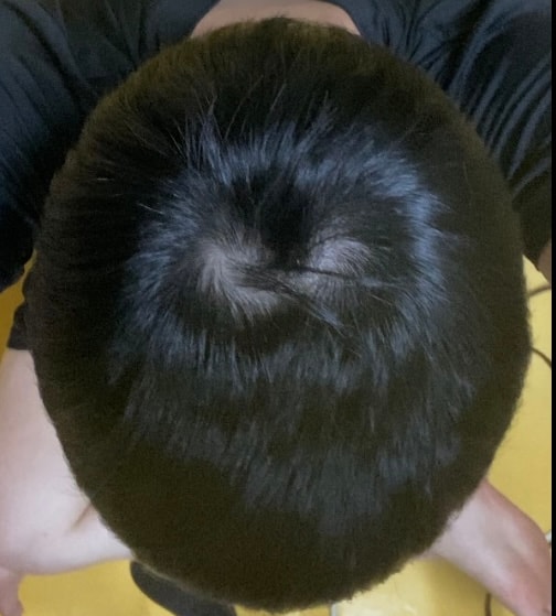 피나스테리드 8개월차 후기