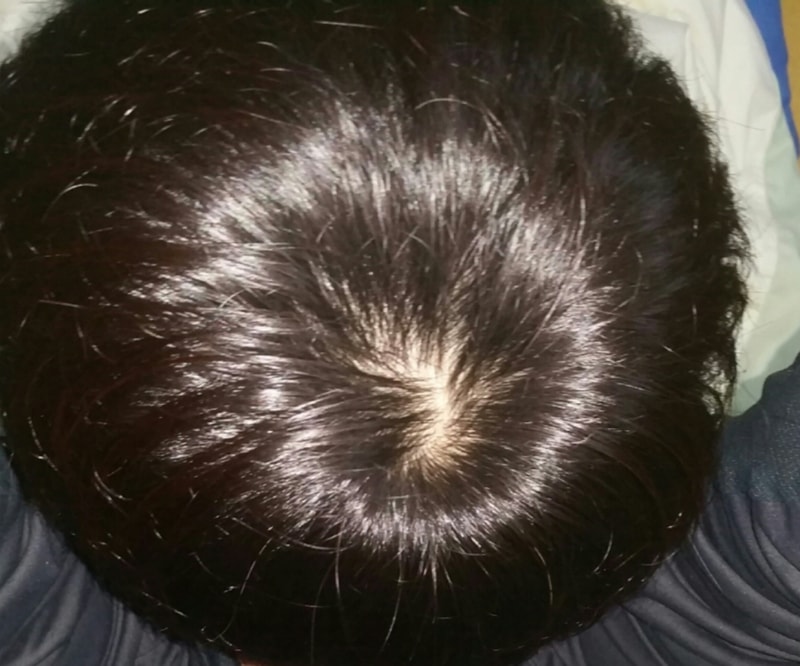 모나드정 8개월 차.. 효과없어보이네요.