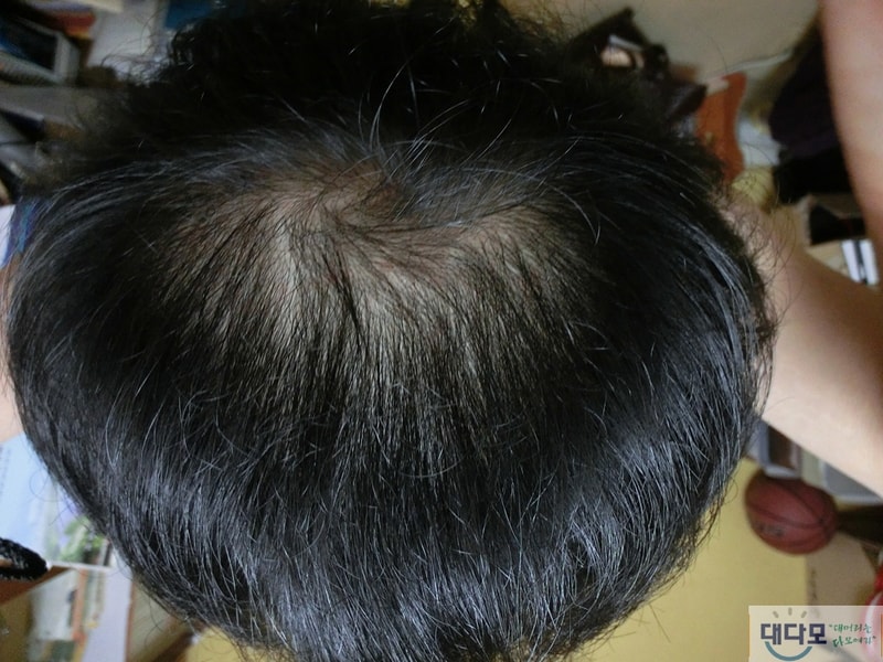 프카 복용 5개월 째... 나아지고 있네요ㅜㅜ