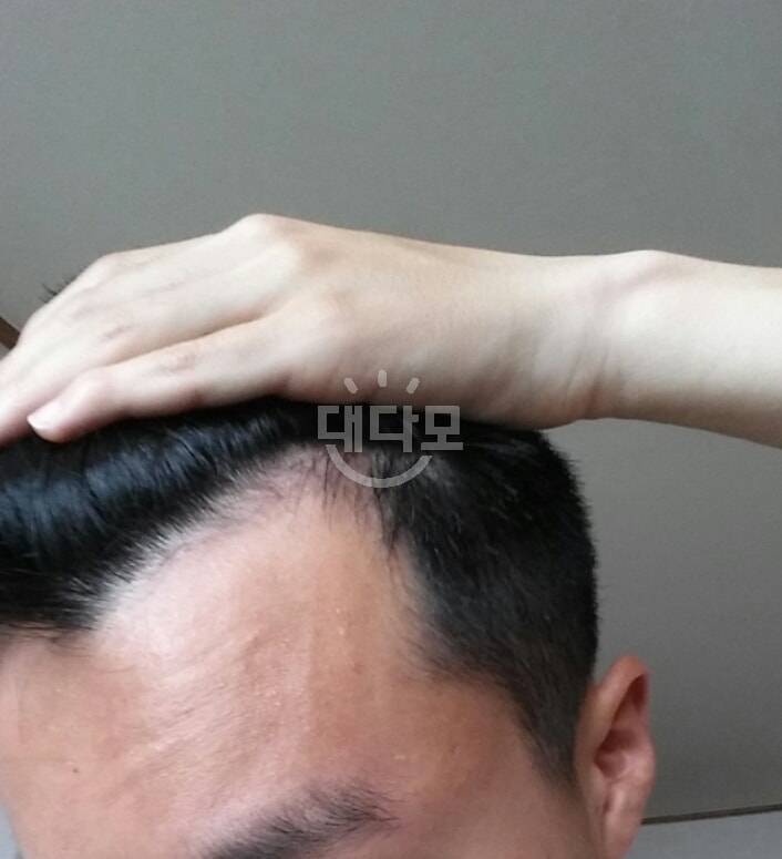 7월 미녹시딜 바르기 전 왼쪽