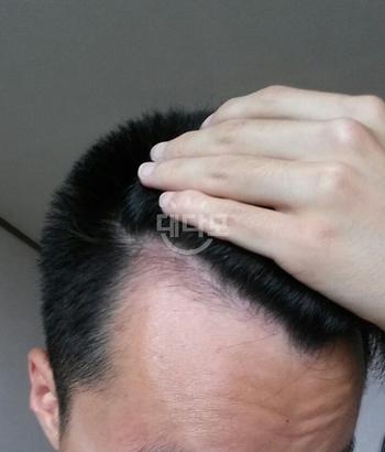 7월 미녹시딜 바르기 전 오른쪽