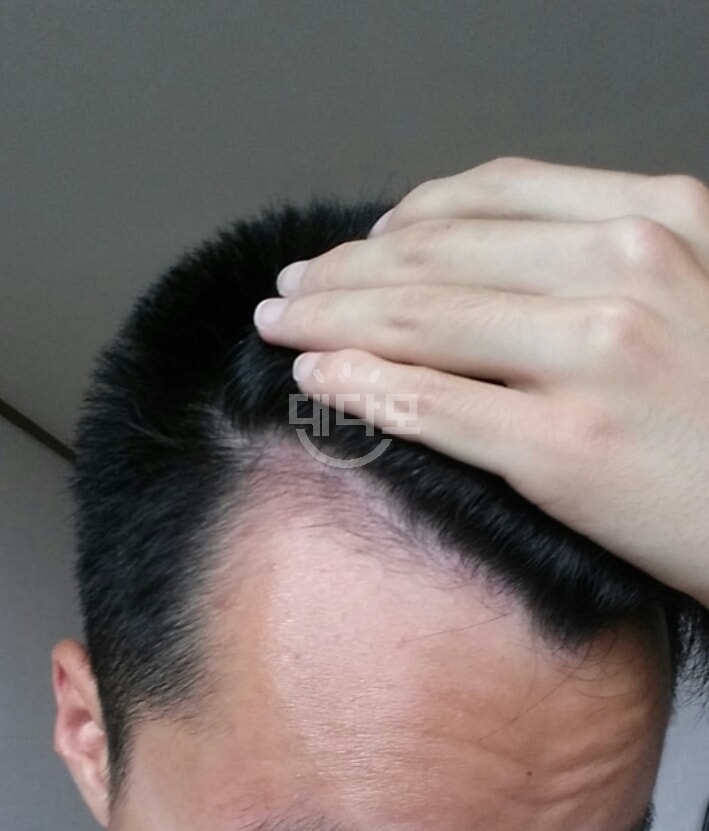7월 미녹시딜 바르기 전 오른쪽