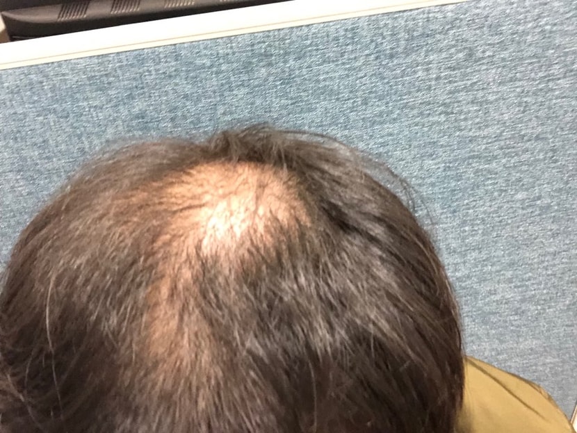 3개월전 약 복용 시작 당시 사진