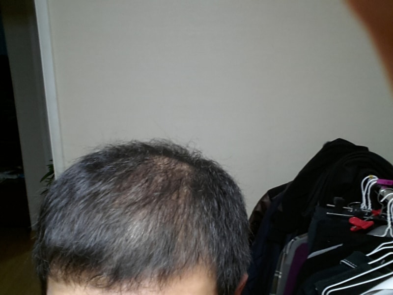 프로페시아 시작 했습니다 ..