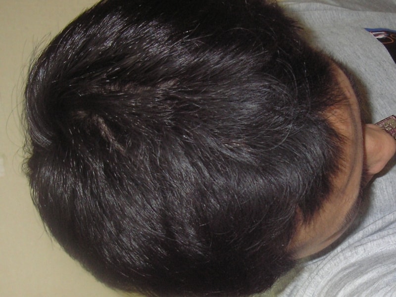 Eight years of hair loss. 6 years of Minok, 4 years of Pfe