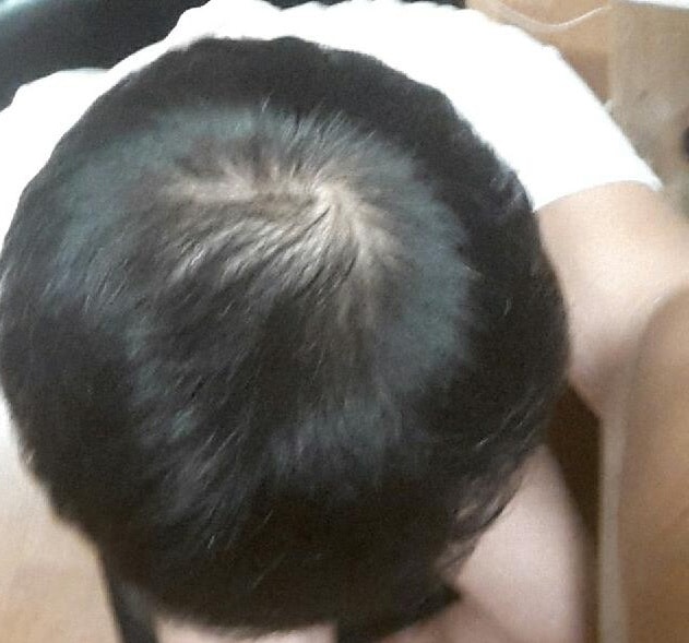 프로스카를 복용한지 4년이 다 되갑니다..