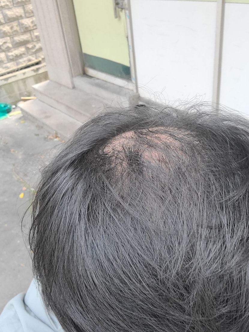 약 먹고 7~9개월차 많이낫네용