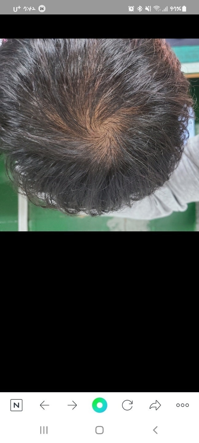 치료시작전