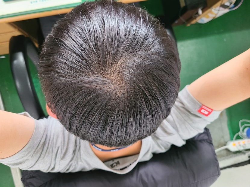 아보다트 + 미녹 83일차