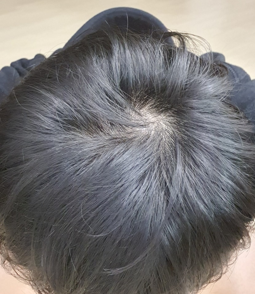 정수리