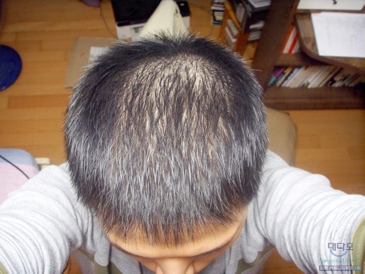 （propesia第7年后期..久违的生存报告！！）