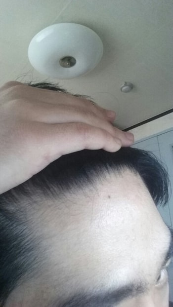 경구약만 복용한 m자2