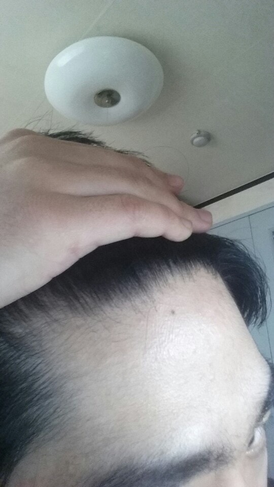 경구약만 복용한 m자2