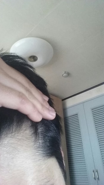 경구약만 복용한 m자1