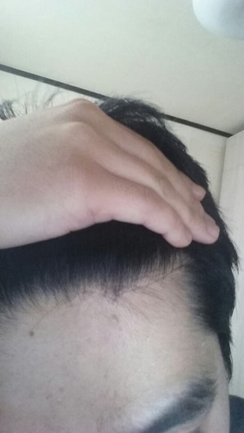 경구약만 복용한 m자3
