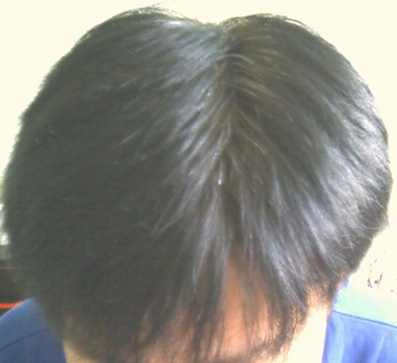 탈모 초기에 프카 8개월 정도 복용[1]..