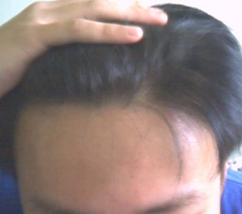 탈모 초기에 프카 8개월 정도 복용[2]..