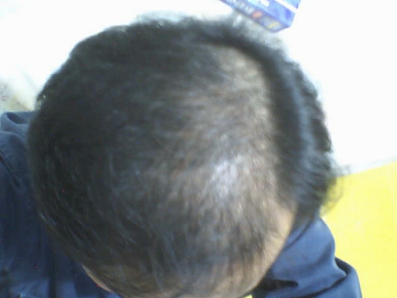 피나스타 6개월 복용기