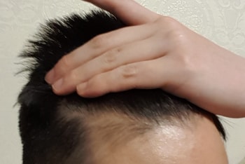 머리깠을때 M자입니다ㅠㅠ