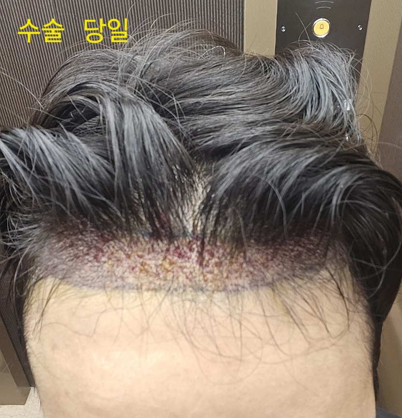 수술직후 병원 엘리베이터