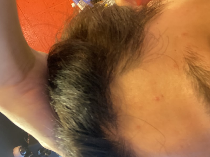 毛发移植快8个月了（12月手术）