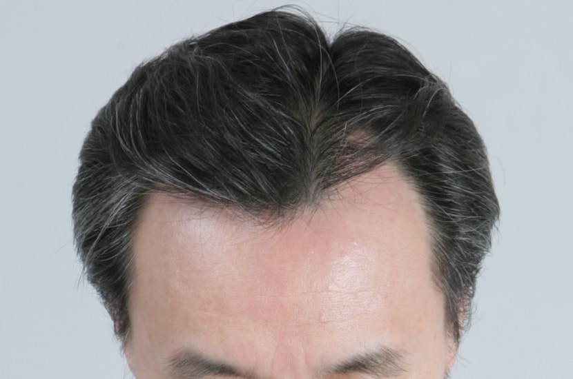 수술전