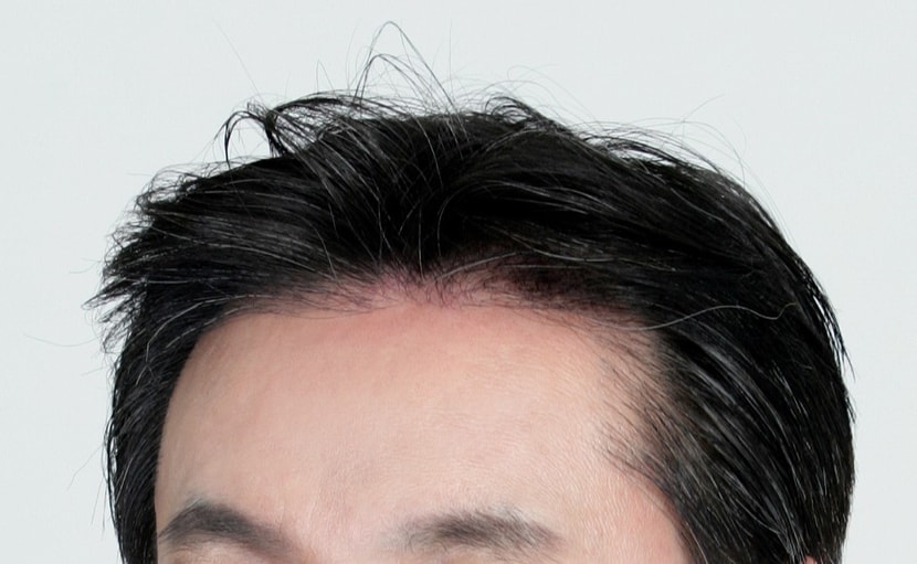 수술후