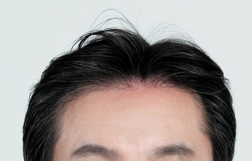 수술후